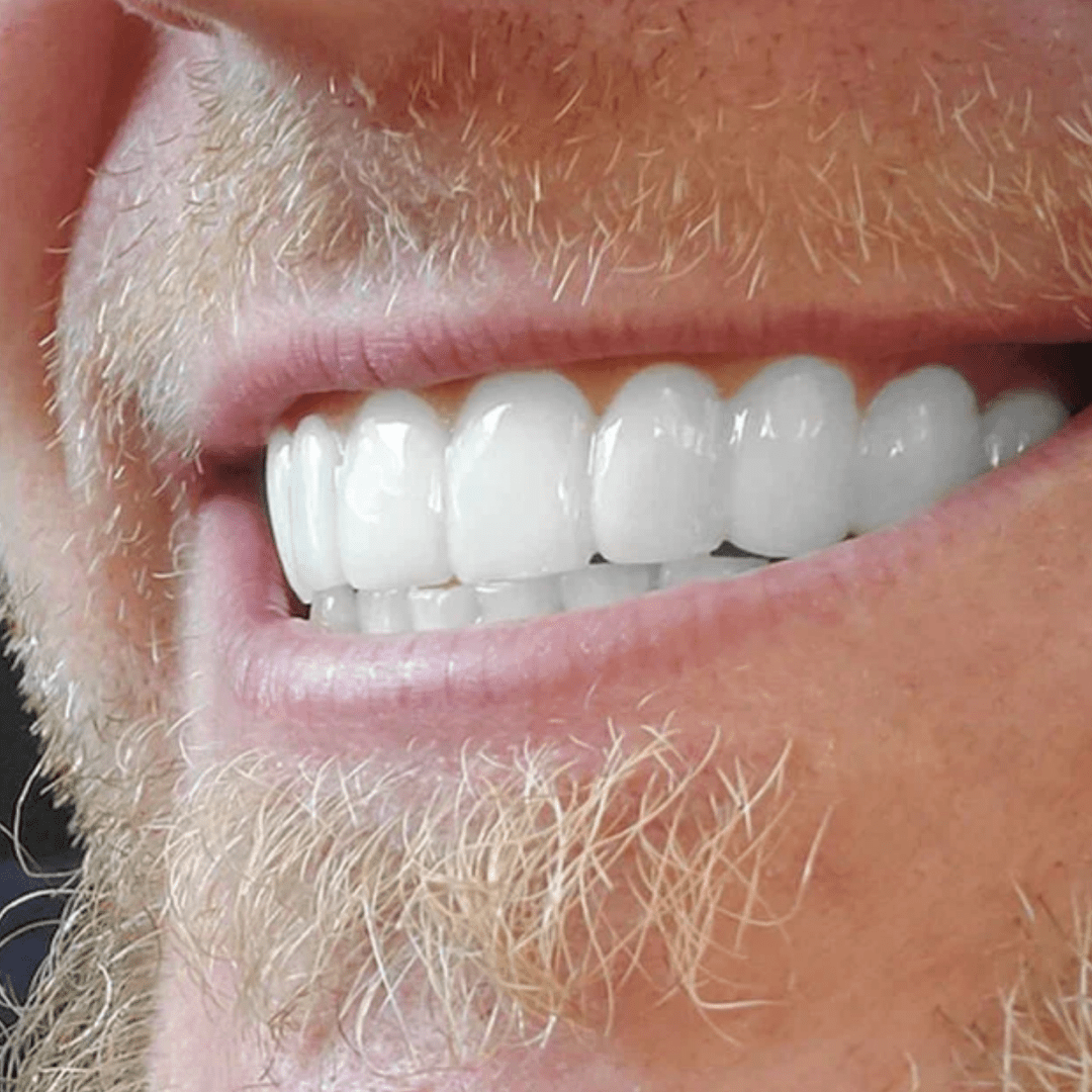 Carillas Dentales Perfecta Sonrisa