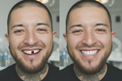 Carillas Dentales Perfecta Sonrisa